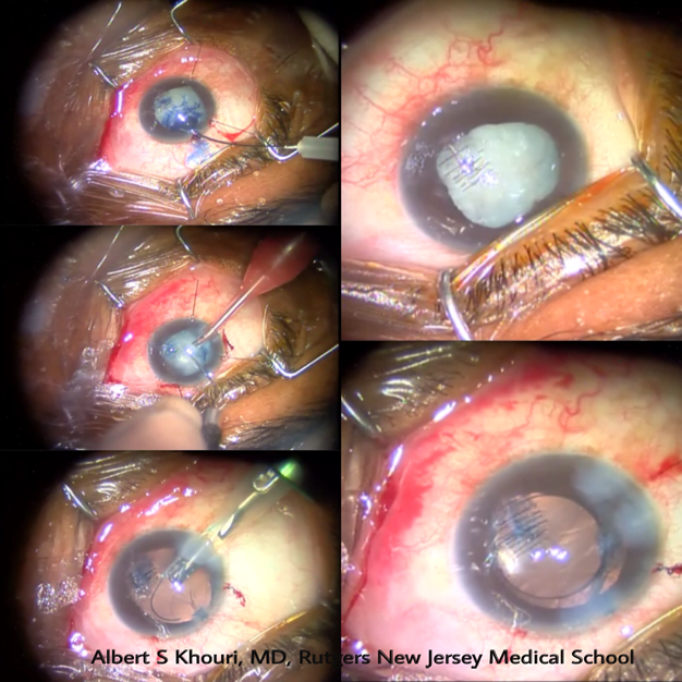 Complex Cataract Surgery