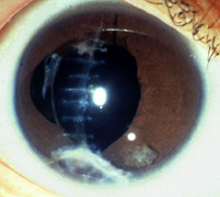 corneal rupture