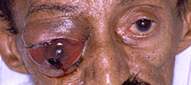ocular tumor