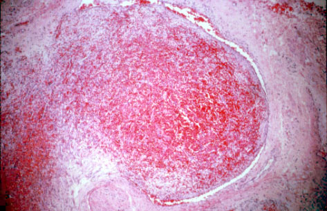 Thrombosed Hemorrhoid Histology